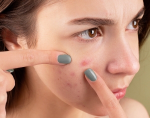 L’acné : origines et traitements