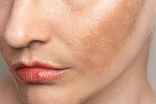Hyperpigmentations du visage : mélasma et hyperpigmentation post-inflammatoire