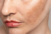 Hyperpigmentations du visage : mélasma et hyperpigmentation post-inflammatoire