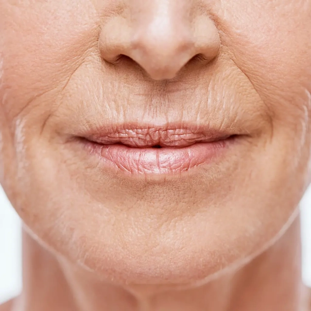 Atténuer les rides autour de la bouche