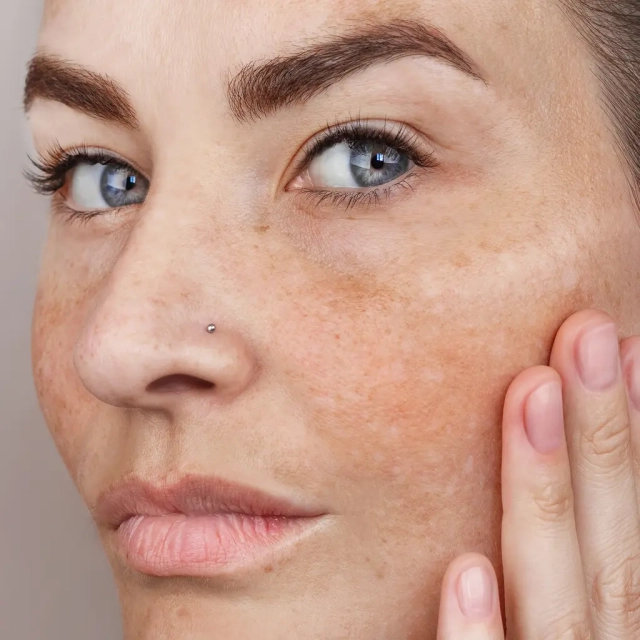 Atténuer les taches brunes et le masque de grossesse